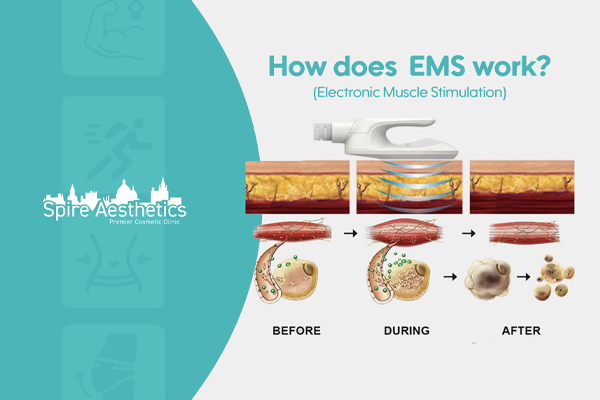 EMS treatment for post pregnancy weight loss treatment Wraysbury