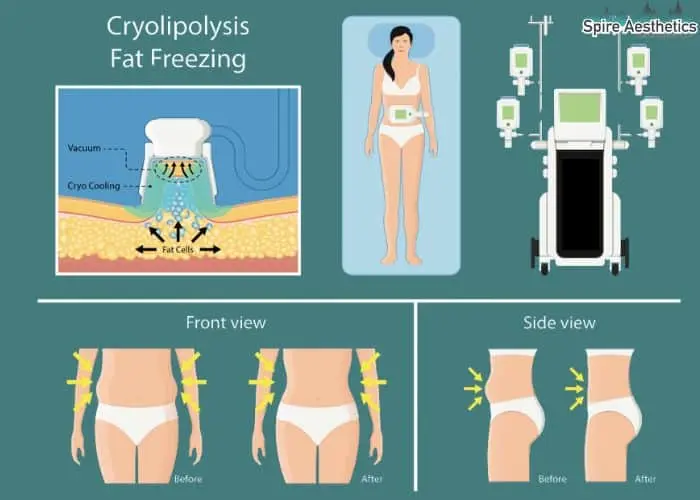 Fat freezing treatment Wraysbury benefits for competitions to remove stubborn fat deposits.