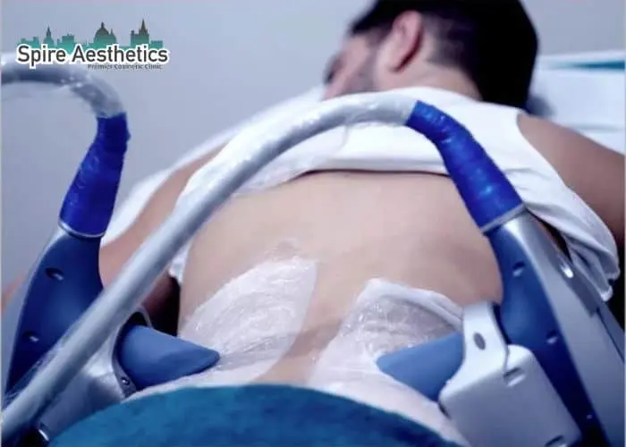 Man having fat freezing treatment done on love handles before a competitions Wraysbury to create a sculpted look.