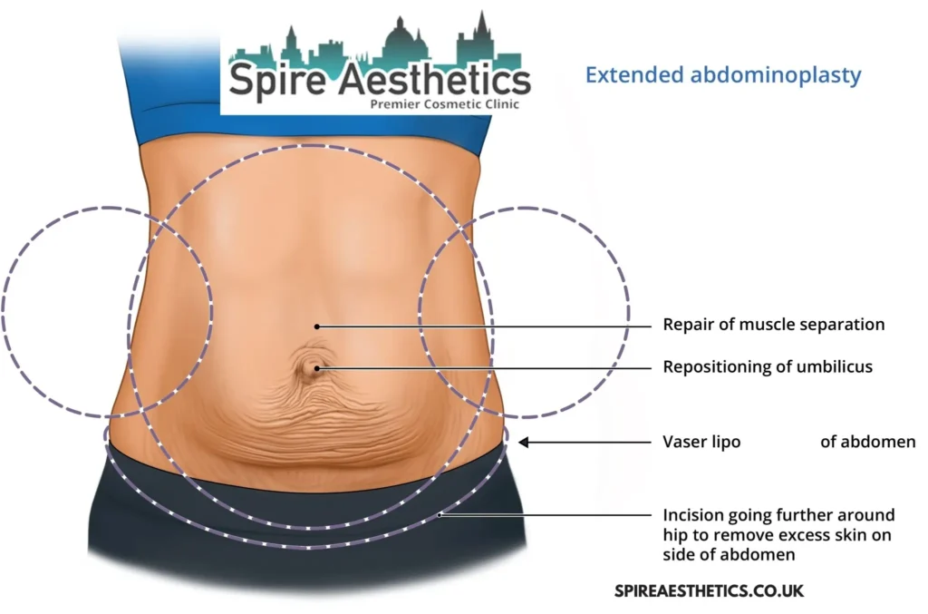 Understanding Loose Skin After Gastric Band Wraysbury Surgery and HIFU Treatment