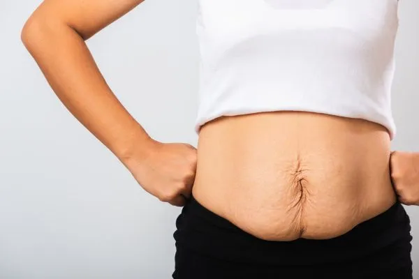 Image of a woman's stomach after weight loss with sagging skin following a gastric band Wraysbury