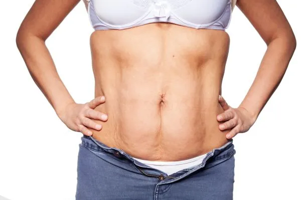 sagging skin on woman's stomach after weight loss injections Wraysbury
