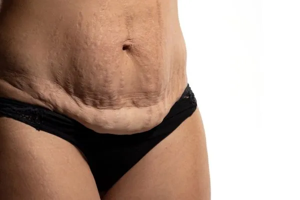 Image of womans stomach after weight loss injections Wraysbury showing saggy skin