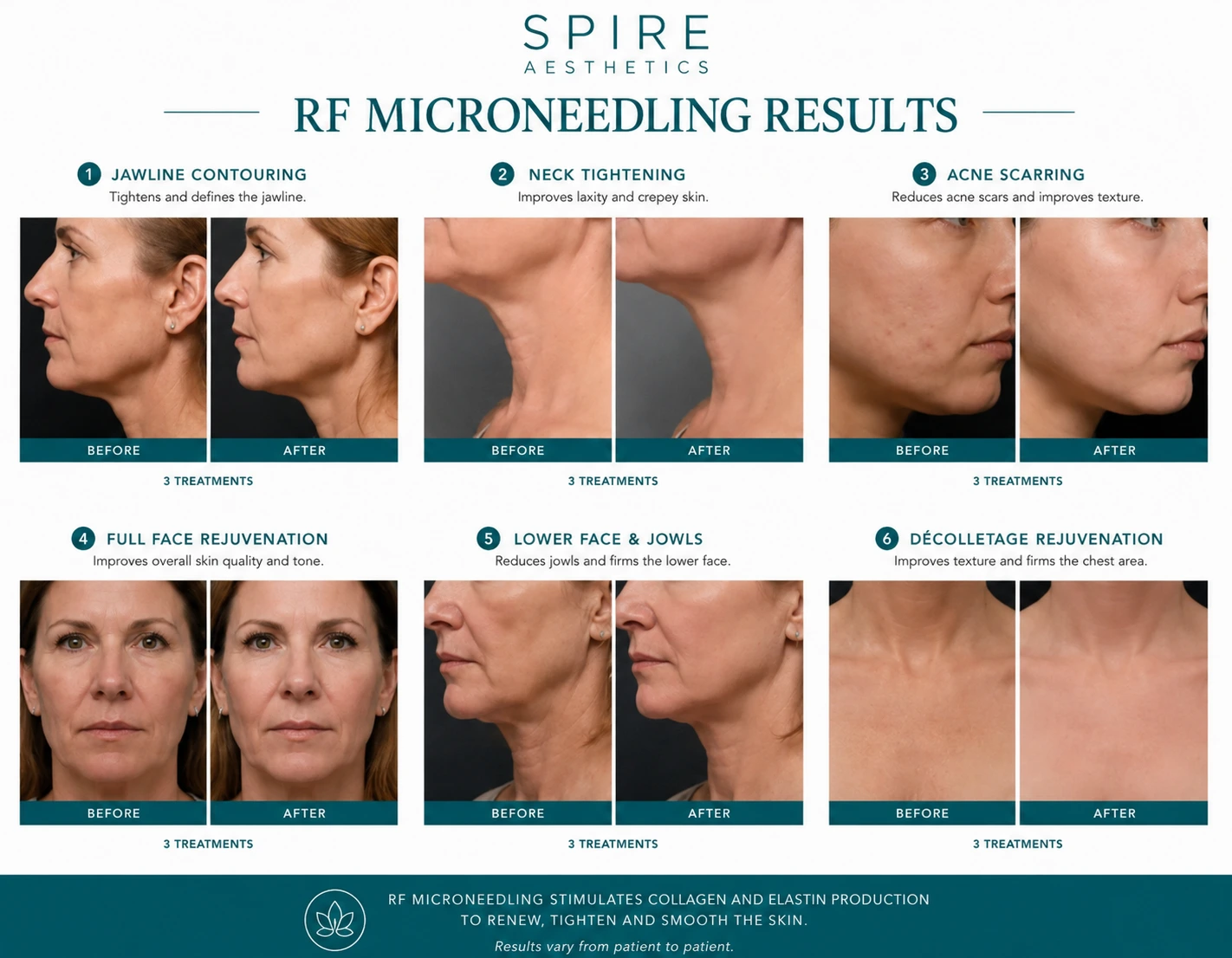 RF Microneedling Skin tightening Wraysbury results