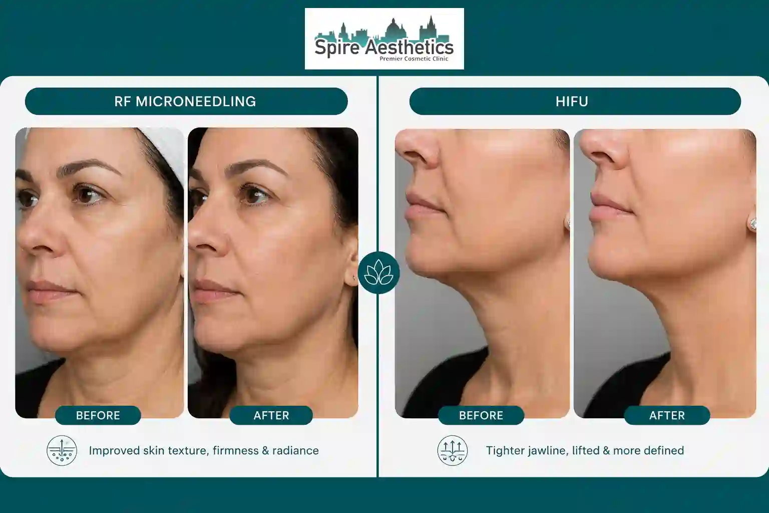 Can RF Microneedling and HIFU Be Combined Wraysbury?
