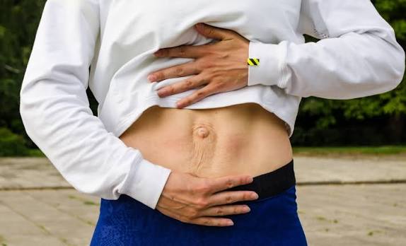When Could Diastasis Recti Be the Missing Piece of the Puzzle Wraysbury?