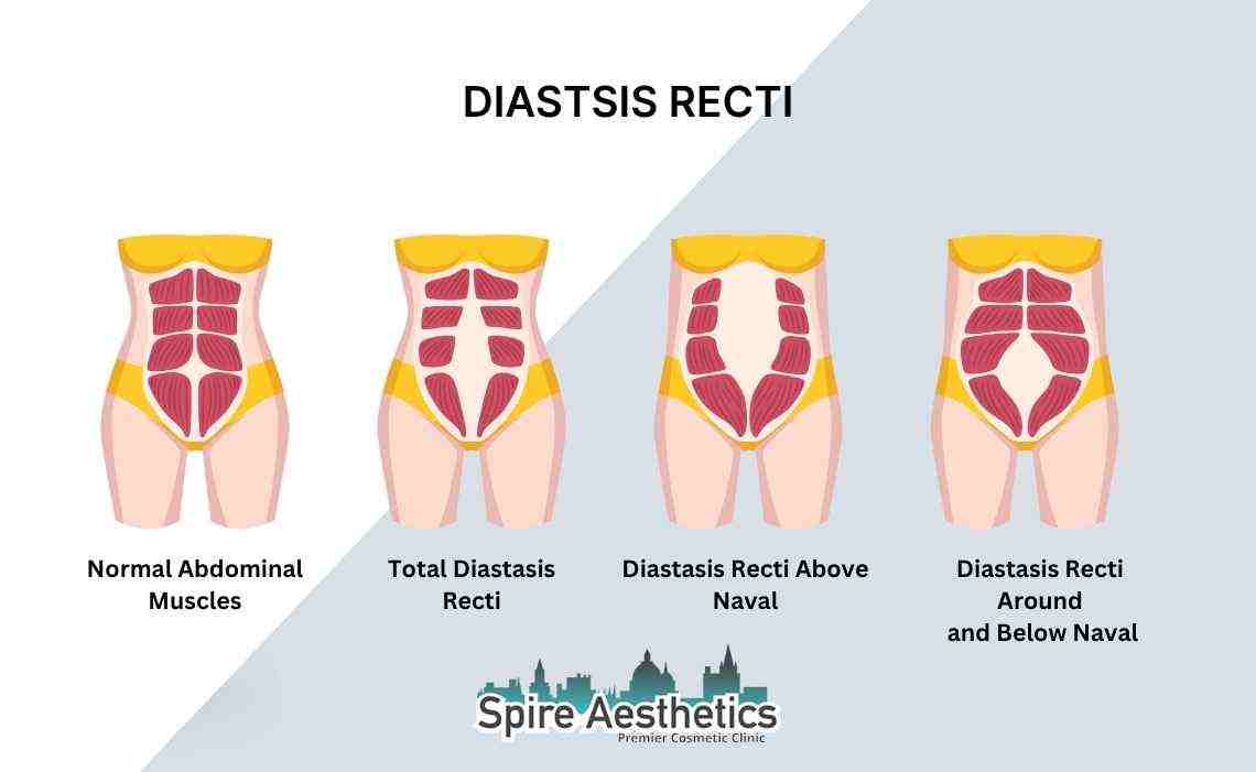 Is Non-Surgical Diastasis Recti Treatment Right for You? Common Concerns Answered Wraysbury